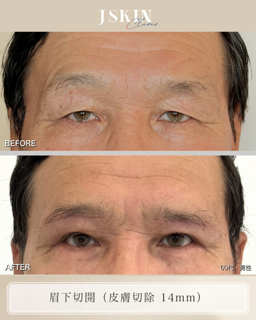 目を開けるのがつらいほどのまぶたのたるみを、眉下切開（皮膚切除14mm）で改善した症例