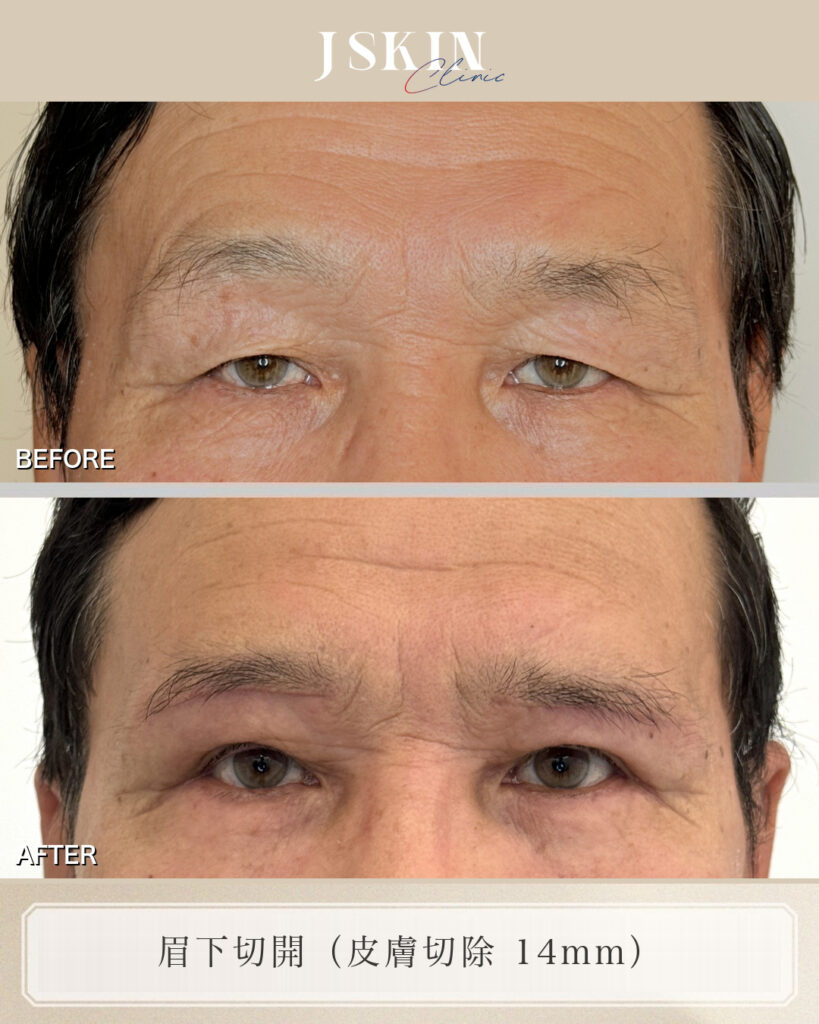 目を開けるのがつらいほどのまぶたのたるみを、眉下切開（皮膚切除14mm）で改善した症例