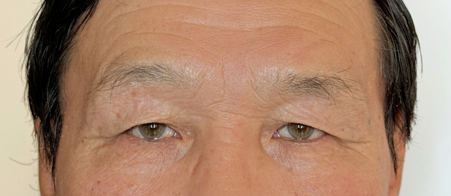 60代男性 眉下切開 術前 正面・開瞼(両目・目もと)